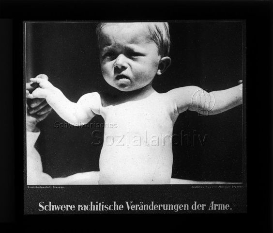 Diaserie zum Thema Kinderkrankheiten; "Schwere rachistische Veränderungen der Arme." - Junge mit stark deformierten Armen; "Kinderheilanstalt Dresden - Deutsches Hygiene-Museum Dresden"; um 1930