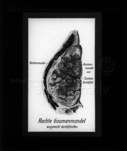 Diaserie zum Thema Kinderkrankheiten; "Rechte Gaumenmandel wagerecht durchschnitten" - Zeichnung: Querschnitt der rechten Gaumenmandel mit eingezeichnetem "Gaumenmuskel" und Stelle an der "Gaumenmandel von Furchen durchsetzt"; um 1930
