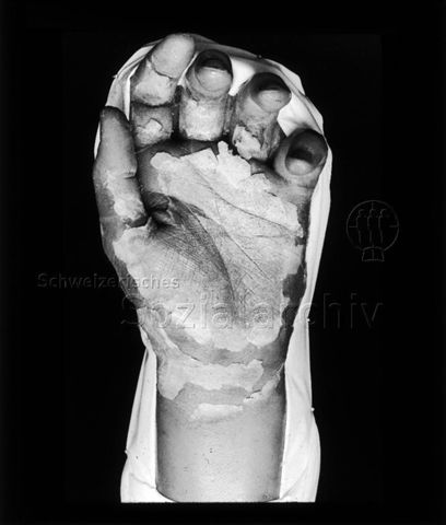Diaserie zum Thema Kinderkrankheiten; starke Abschälung der Haut bei abheilendem Scharlach; Hand mit sich ablösender Haut; um 1930