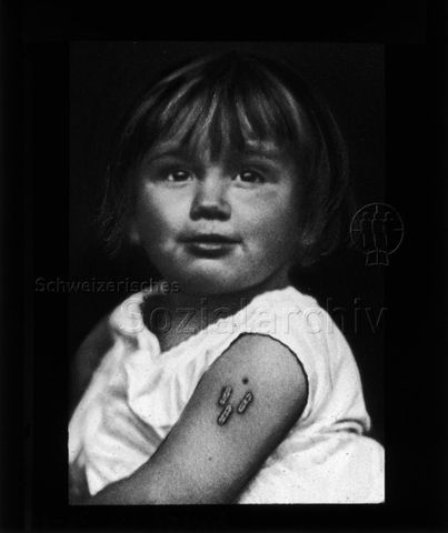 Diaserie zum Thema Kinderkrankheiten; Mädchen mit Impfpocken am Oberarm; um 1930