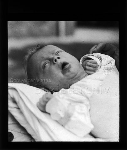 Diaserie zum Thema Kinderkrankheiten; Säugling während eines Keuchustenanfalls; um 1930