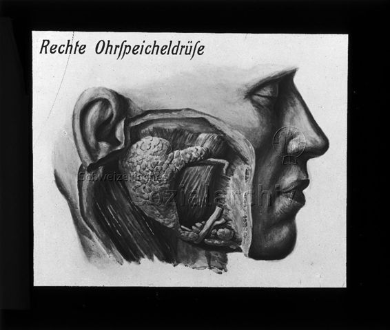 Diaserie zum Thema Kinderkrankheiten; "Rechte Ohrspeicheldrüse" - Querschnitt durch rechte Wange eines Mannes; um 1930