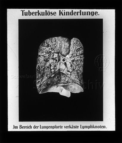 Diaserie zum Thema Tuberkulose im Kindesalter; "Tuberkulöse Kinderlunge. - Im Bereich der Lungenpforte verkäste Lymphknoten." - Deutsches Hygiene-Museum; um 1930