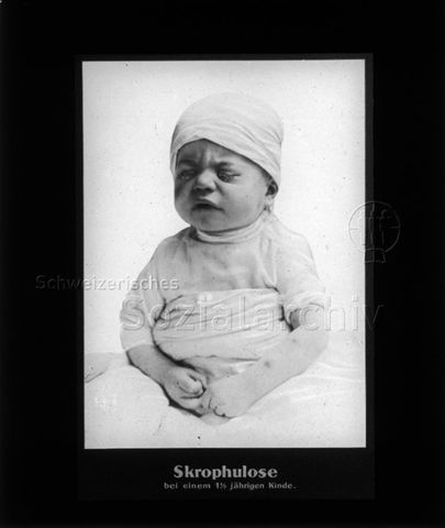 Diaserie zum Thema Tuberkulose im Kindesalter; "Skrophulose bei einem 1 1/2 jährigen Kinde." - Kleinkind mit verklebten Augen; Deutsches Hygiene-Museum; um 1930