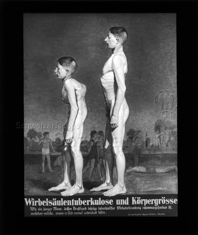 Diaserie zum Thema Tuberkulose im Kindesalter; "Wirbelsäulentuberkulose und Körpergröße. - Wie ein junger Mann, dessen Brustkorb infolge tuberkulöser Wirbelerkrankung zusammengesunken ist, aussehen würde, wenn er sich normal entwickelt hätte." - Zeichnung: junger Mann mit deformierten Rücken vor Mann mit normalen Körperbau stehend; Deutsches Hygiene-Museum; um 1930
