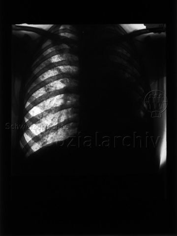 Diaserie zum Thema Tuberkulose; "Thurgauisch-Schaffhausische Heilstätte Davos-Platz - Schwere exsudative Tuberkulose der linken Lunge, disseminierte Herde der rechten Lunge (Patient G. St.)" - Röntgenaufnahme von einem Brustkorb; um 1930