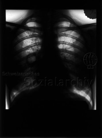 Diaserie zum Thema Tuberkulose; "Thurgauisch-Schaffhausische Heilstätte Davos-Platz - Rechtsseitige Lungentuberkulose mit Hiluscaverne (Patient A. R.)" - Röntgenaufnahme von einem Brustkorb; um 1930
