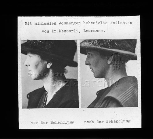 Diaserie zum Thema Kropfprophylaxe; "Mit minimalen Jodmengen behandelte Patienten von Dr. Messerli, Lausanne." - Porträts einer Frau vor und nach der Behandlung ihres Kropfes; um 1920